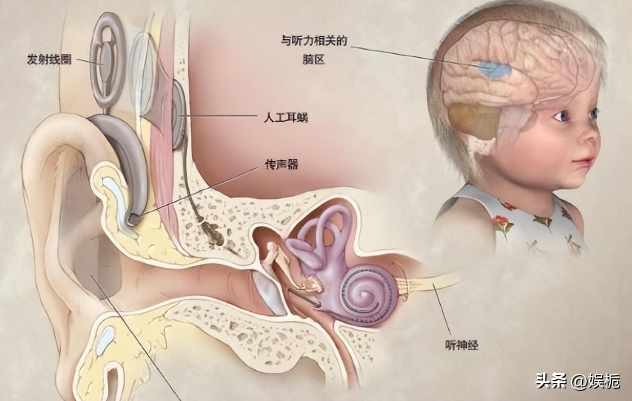 人工耳蜗的手术问0爱耳时代_做人工耳蜗手术视频_人工耳蜗的手术咨询0爱耳时代